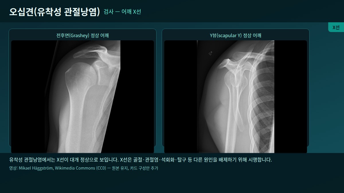 어깨 X선 — 전후면·Y뷰