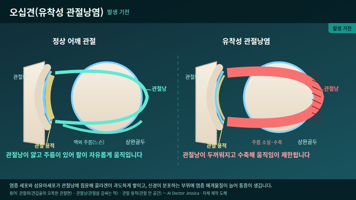 정상 관절낭과 유착성 관절낭염 비교