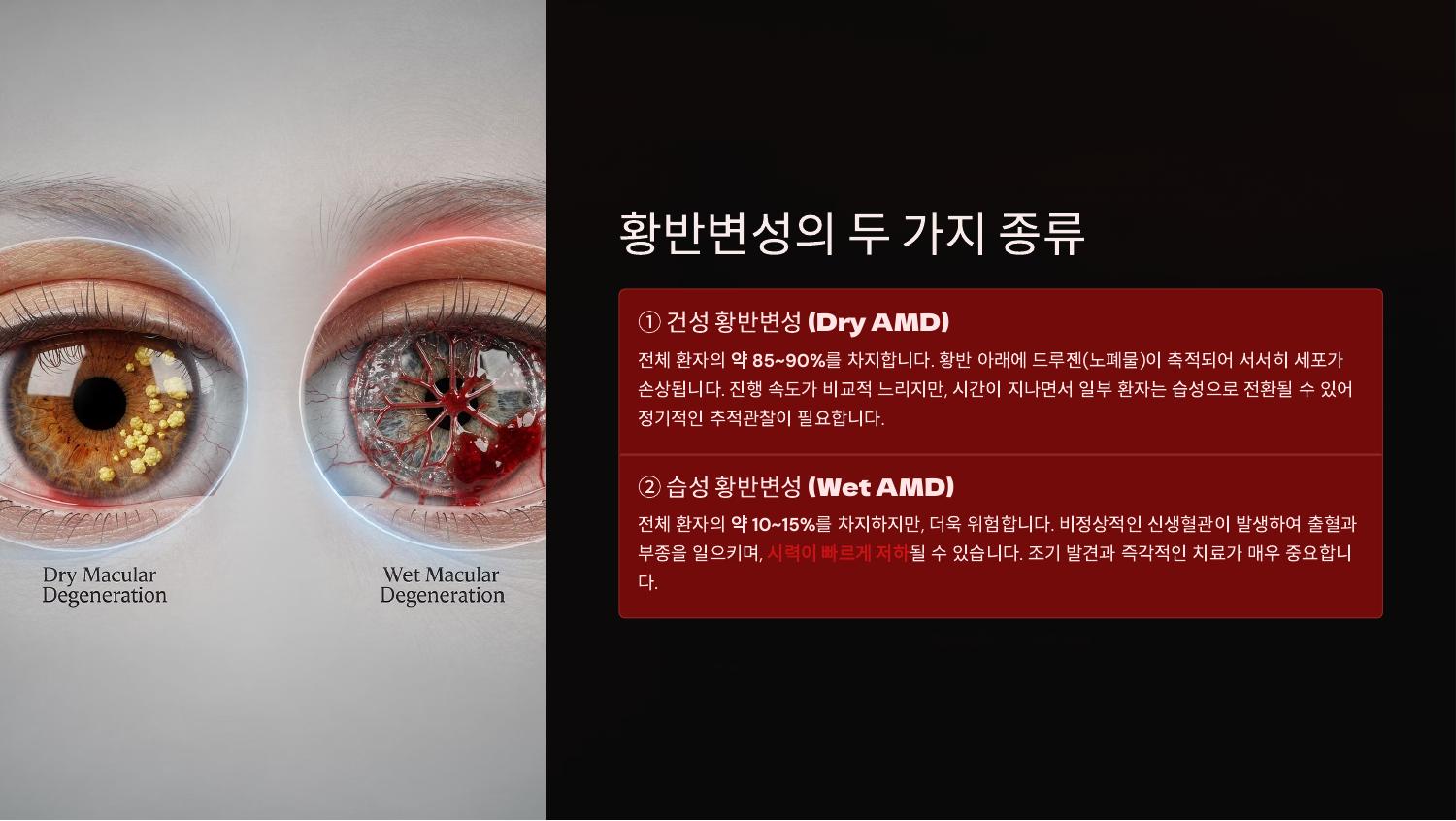 황반변성의 두 가지 종류