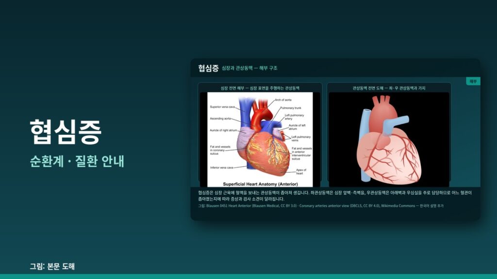 협심증(Angina Pectoris) 완전 가이드