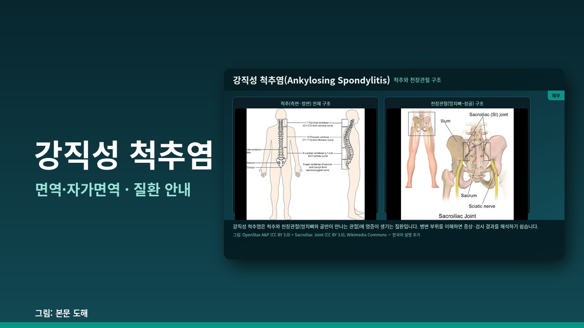 강직성 척추염 — 면역·자가면역