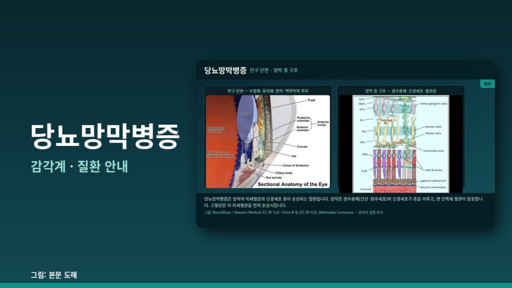 당뇨망막병증(Diabetic Retinopathy) 완전 가이드