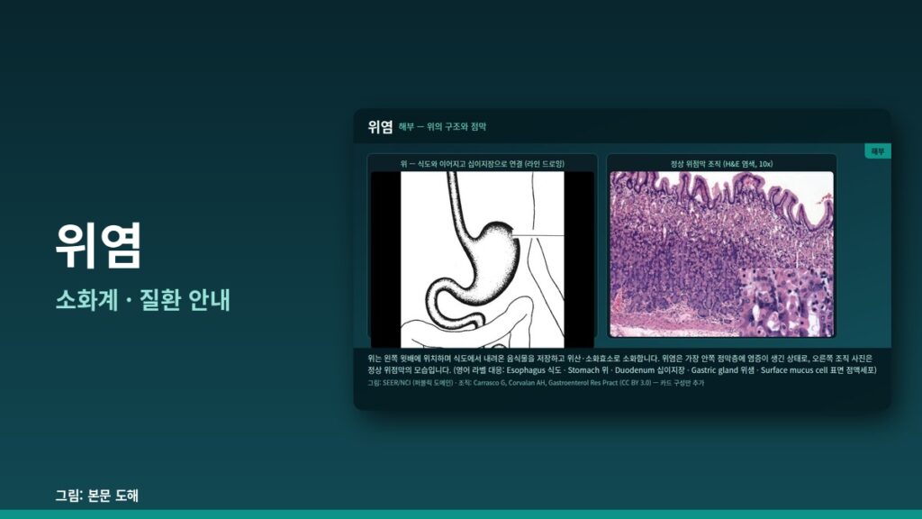 위염(Gastritis) 완전 가이드