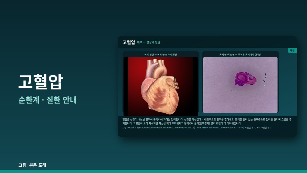 고혈압 — 순환계