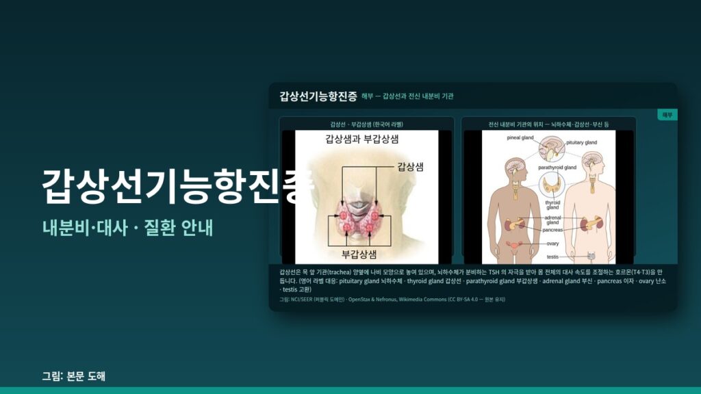 갑상선기능항진증 — 내분비·대사