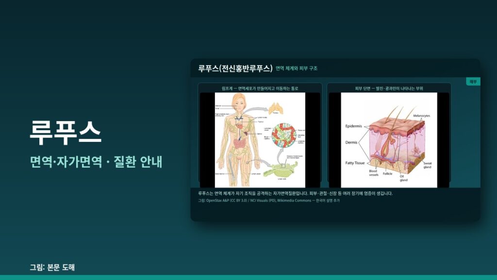 루푸스 — 면역·자가면역
