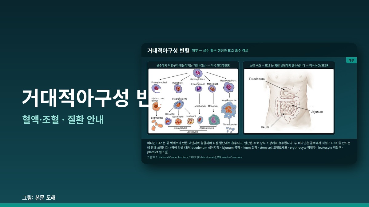 거대적아구성 빈혈 — 혈액·조혈