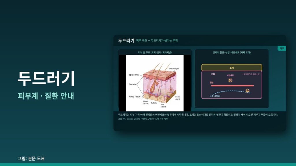 두드러기 — 피부계