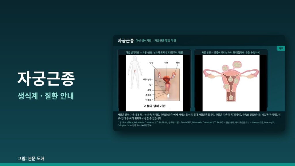 자궁근종 — 생식계