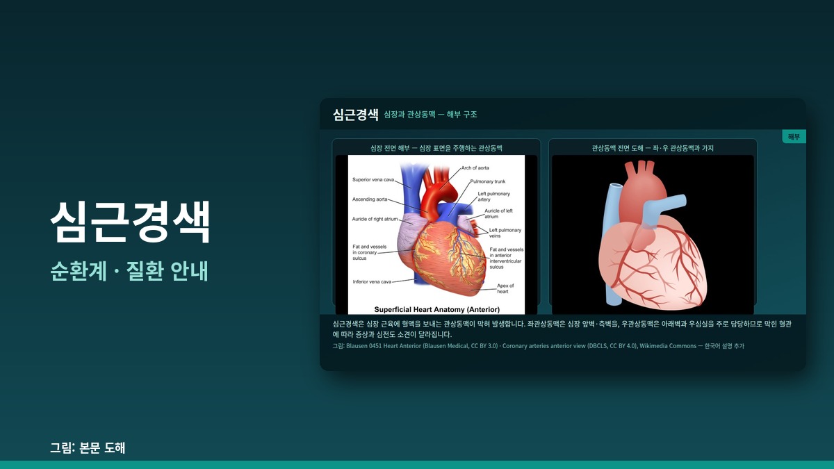 심근경색 — 순환계